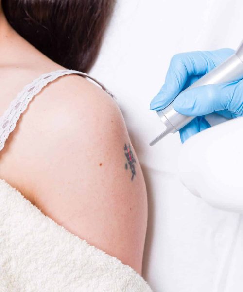 laser-hair-skin-centre_laser-tattoo